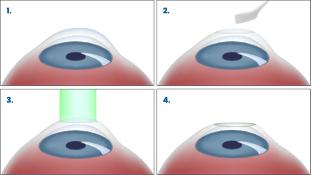 مراحل انجام عمل لازک