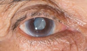 راهنمای جامع آب سیاه چشم + درمان و نکات پیشگیری از بیماری