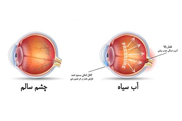 علت بروز گلوکوم یا آب سیاه