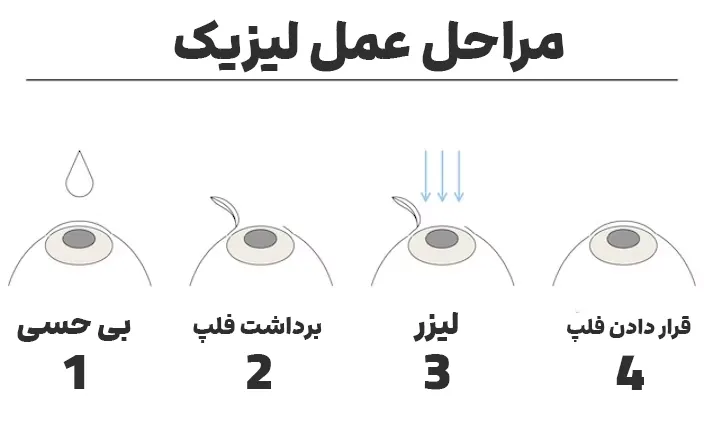 مراحل عمل لیزیک