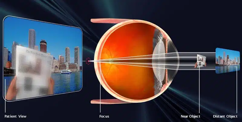 پیرچشمی چیست؟