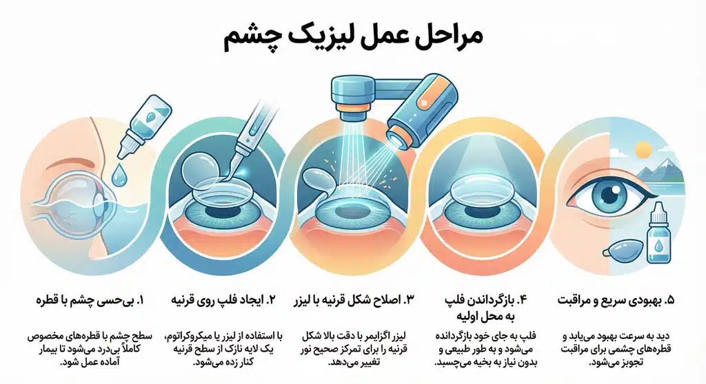 مراحل انجام عمل لیزیک چشم