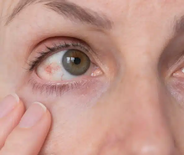 فشار چشم چیست و چه زمانی خطرناک میشود؟