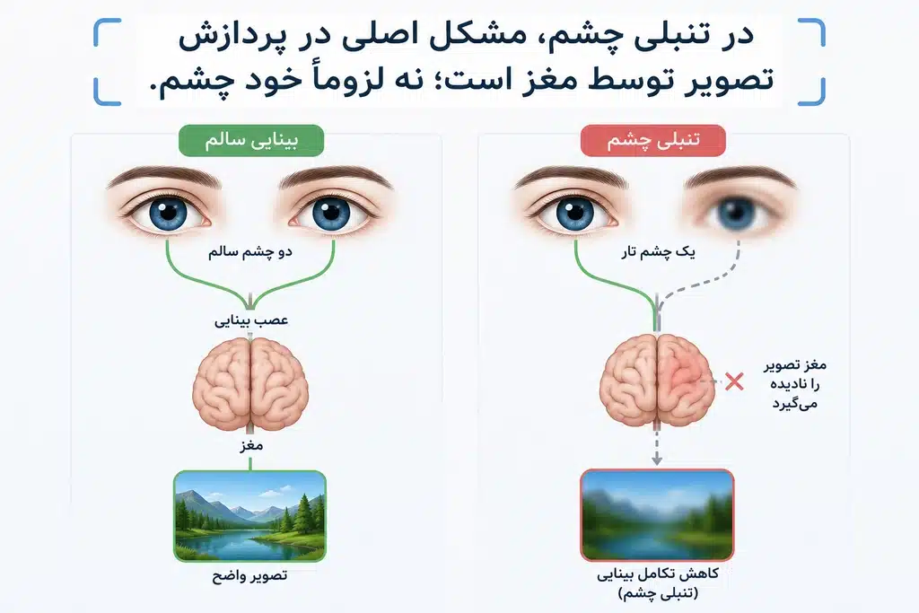 تنبلی چشم چیست و چرا ایجاد می شود؟