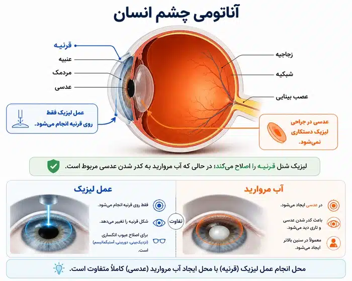 عمل لیزیک روی کدام قسمت چشم انجام میشود؟