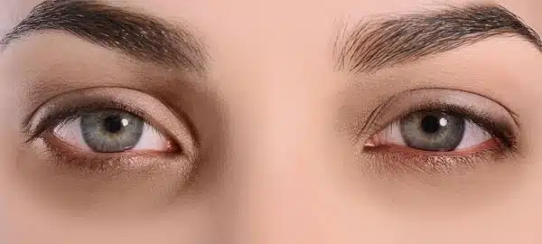 Anisometropia
