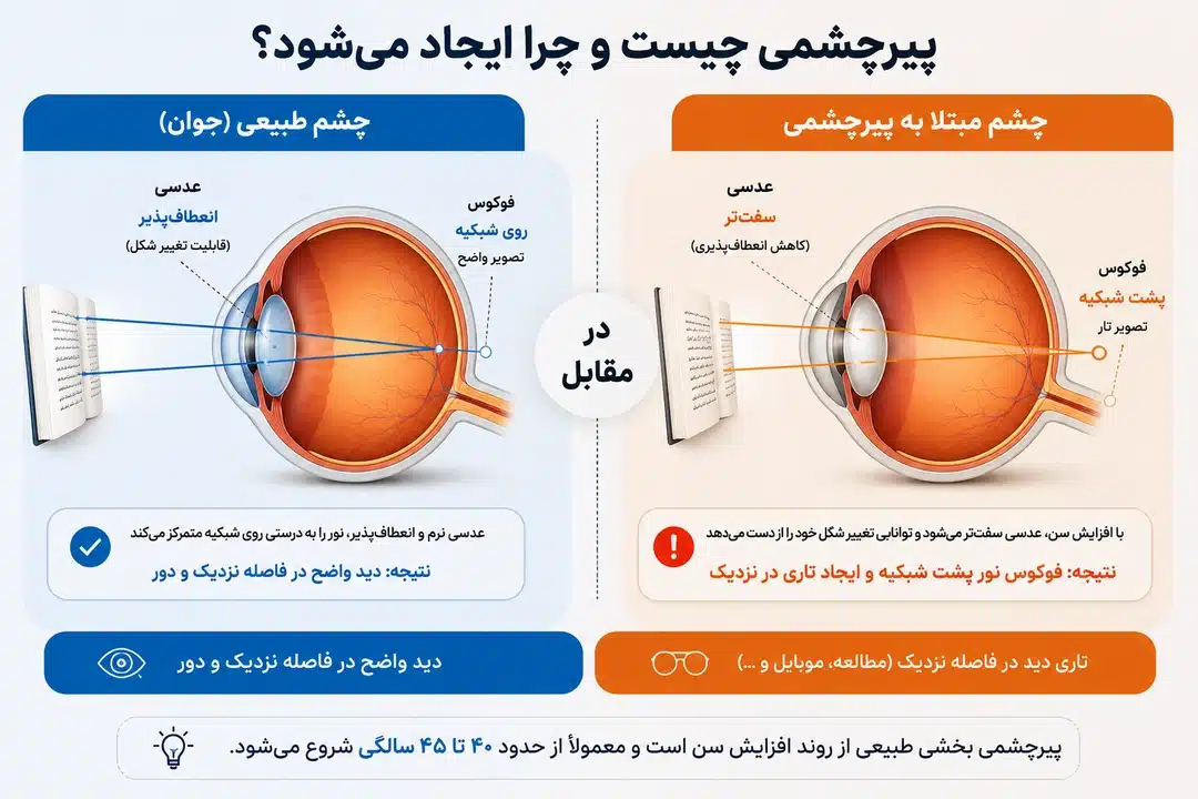 پیرچشمی چیست و چرا ایجاد می شود؟