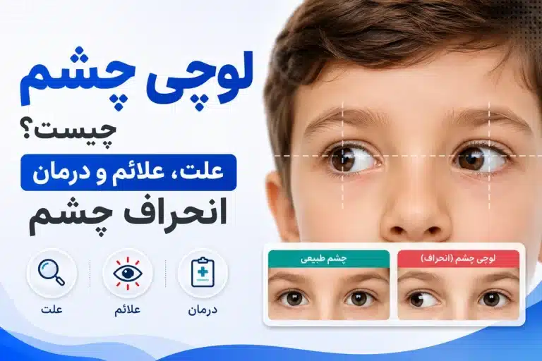 لوچی چشم چیست؟ علت، علائم و درمان انحراف چشم