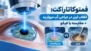 فمتوکاتاراکت انقلاب لیزر در جراحی آب مروارید + مقایسه با فیکو