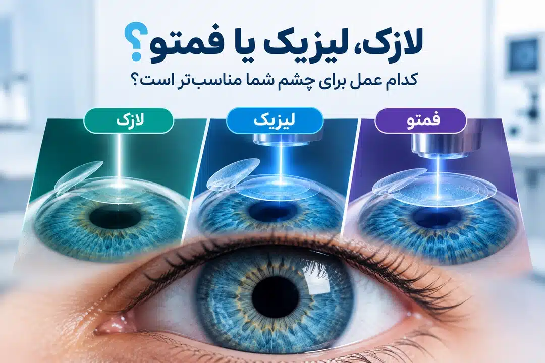 لازک، لیزیک یا فمتو؟ کدام عمل برای چشم شما مناسب‌تر است؟